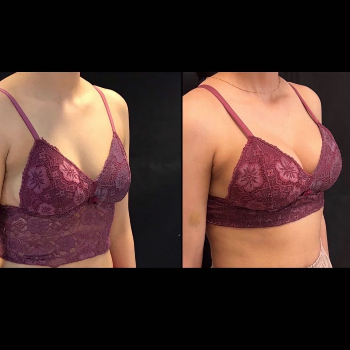 Breast augmentation