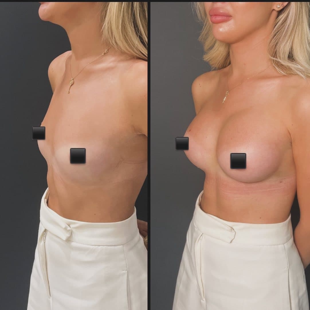 Breast implant 2