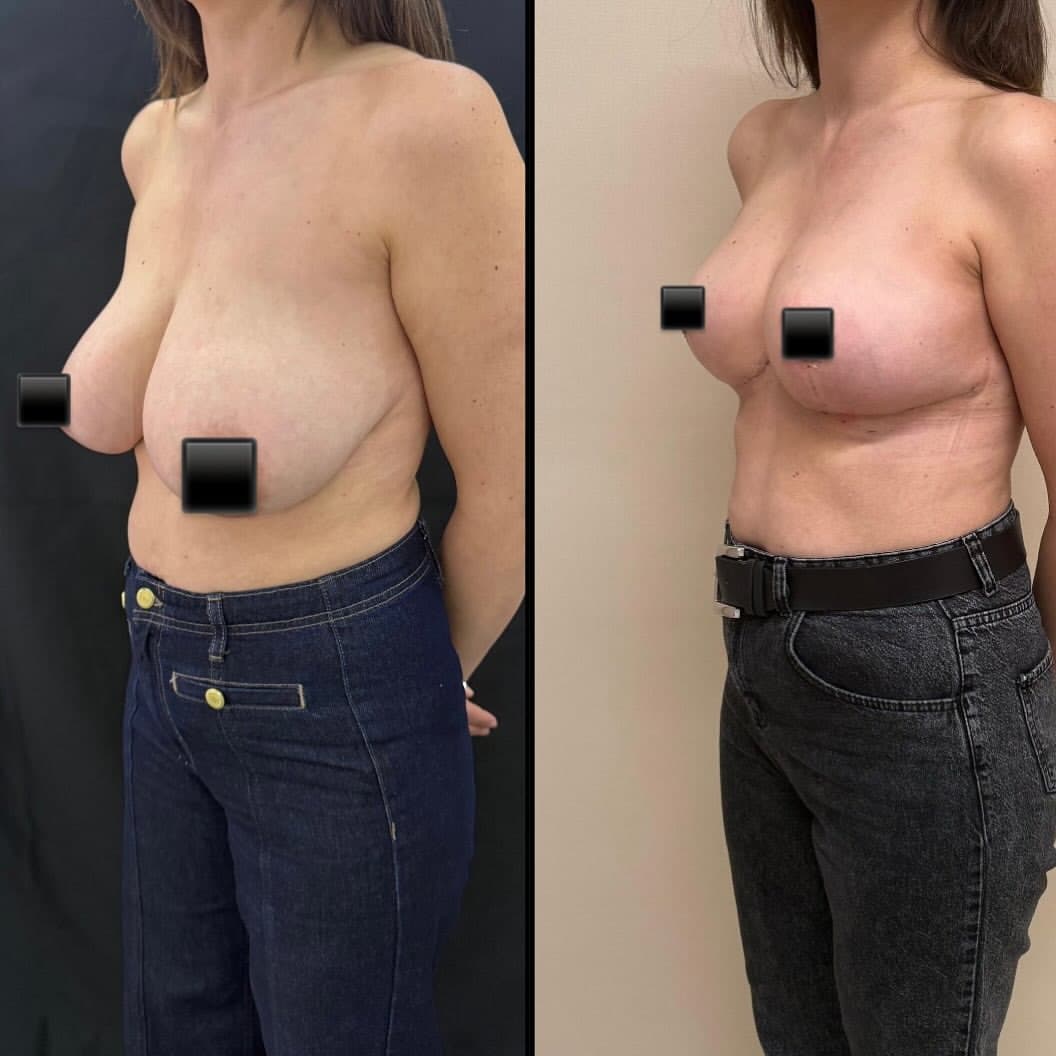 Breast lift