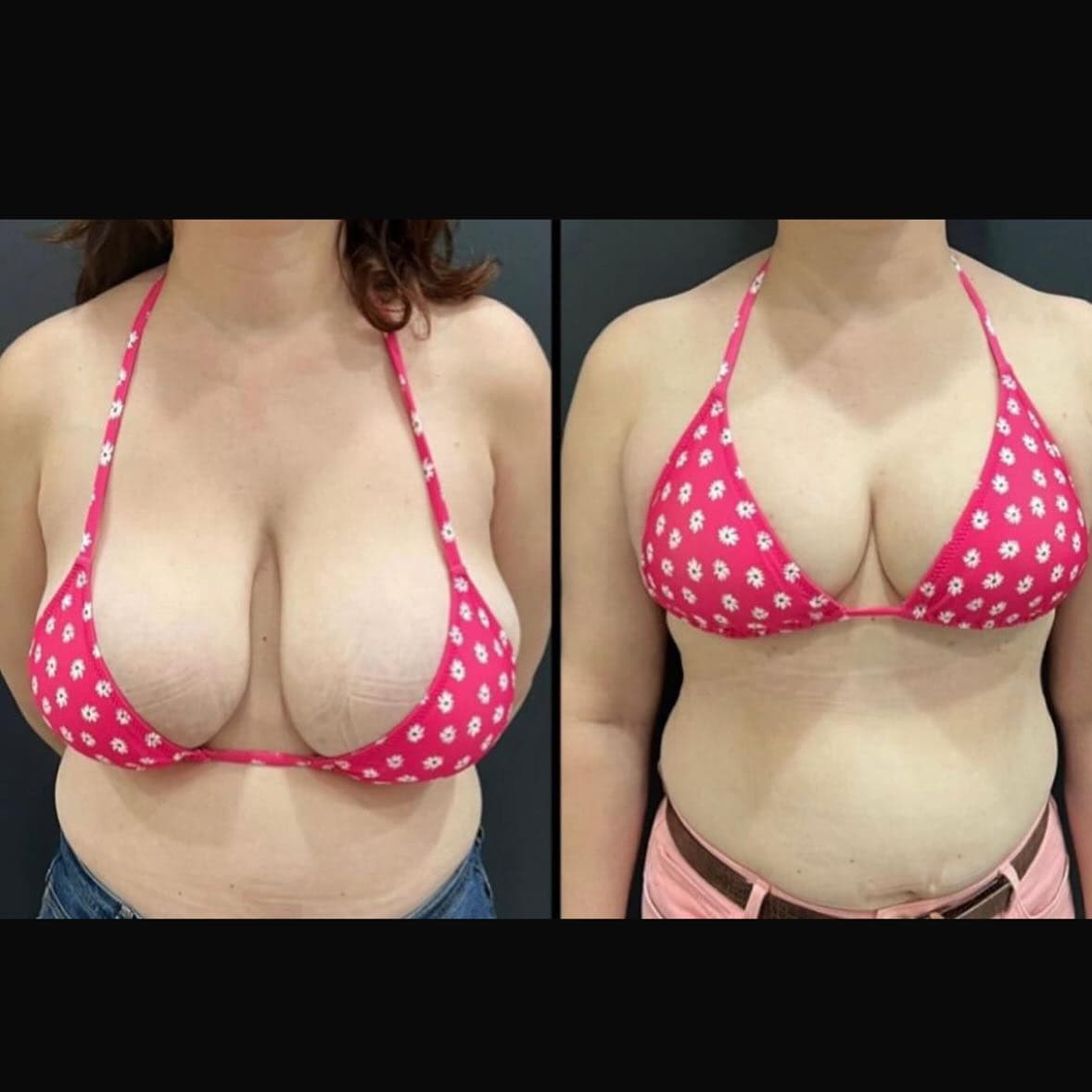 Breast reduction and breast lift