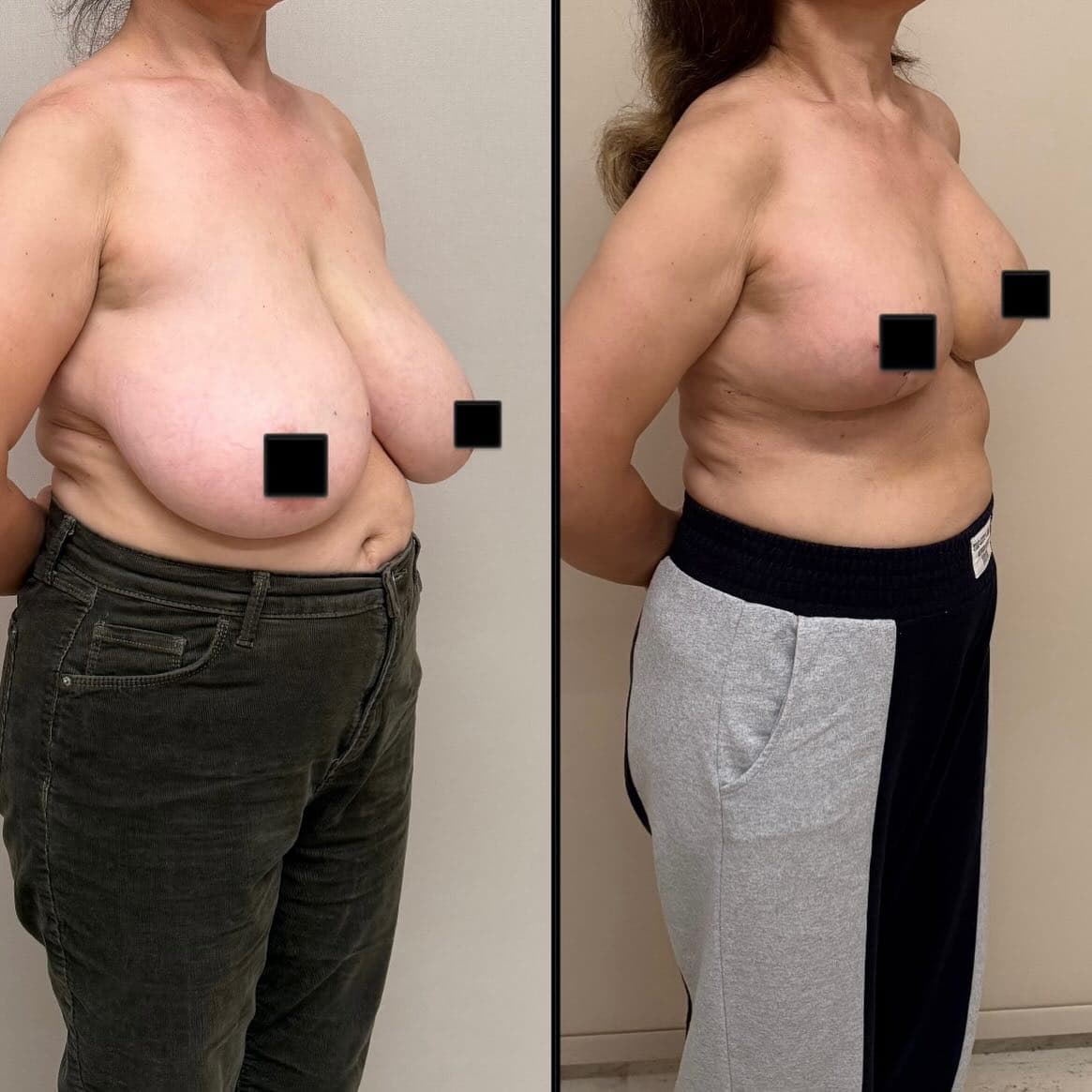 Breast reduction face center left