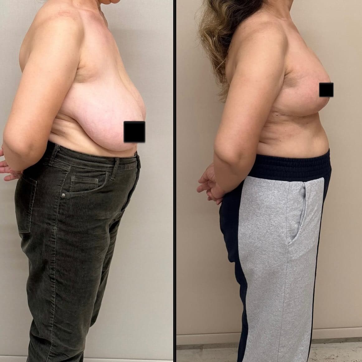 Breast reduction face left