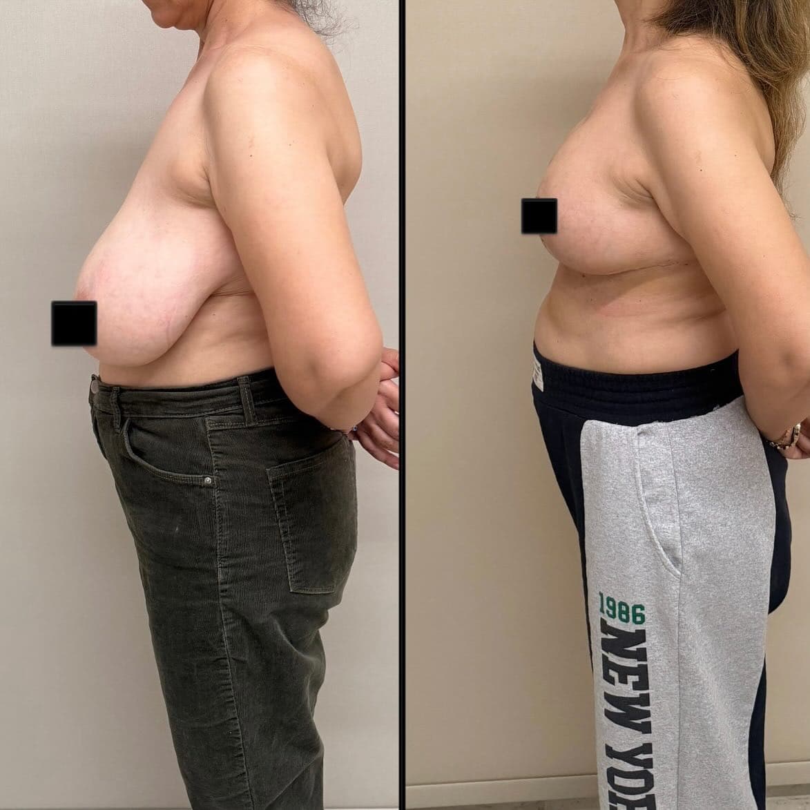 Breast reduction face right