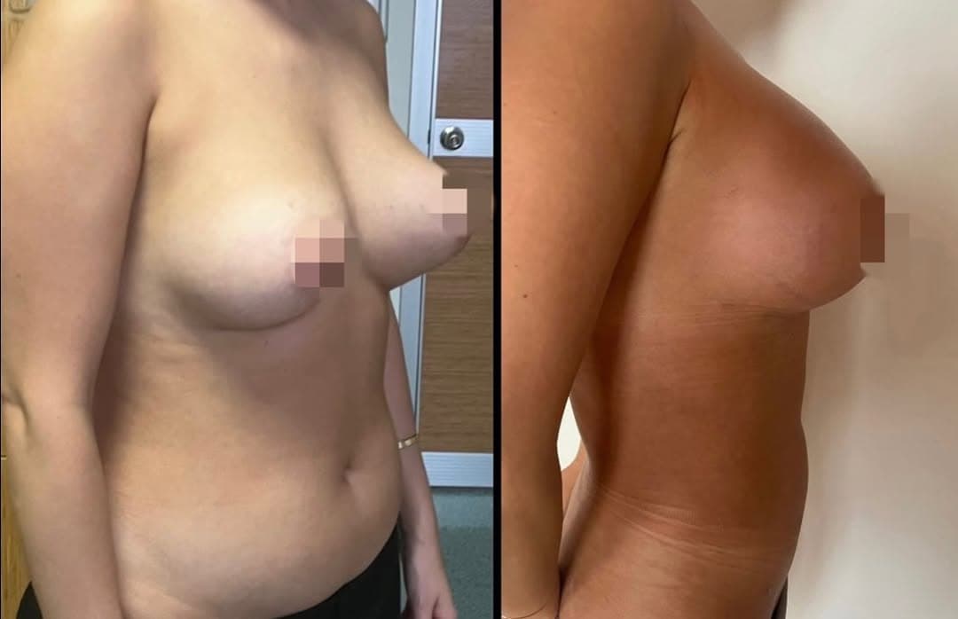 Liposuction and breast implant