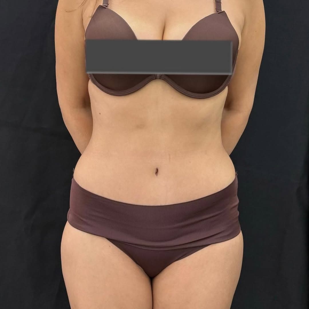 Liposuction and tummy tuck face center new