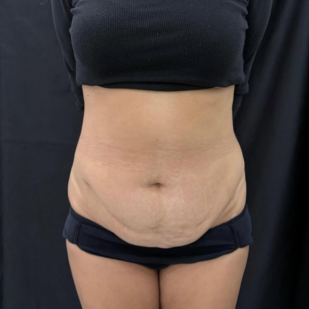 Liposuction and tummy tuck face center old