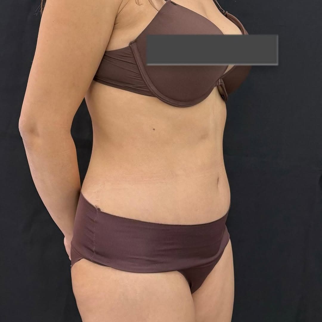 Liposuction and tummy tuck face left new