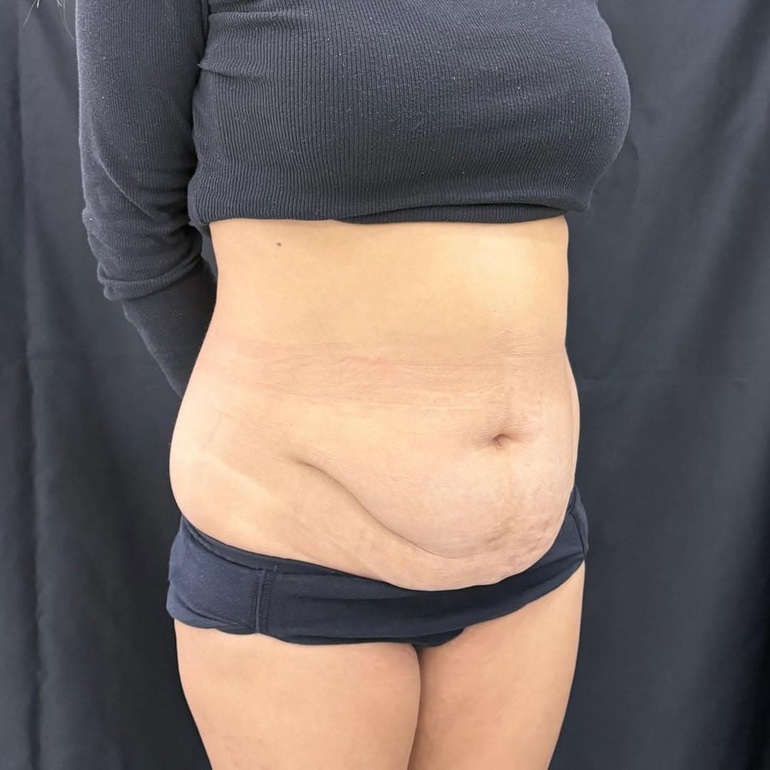 Liposuction and tummy tuck face left old