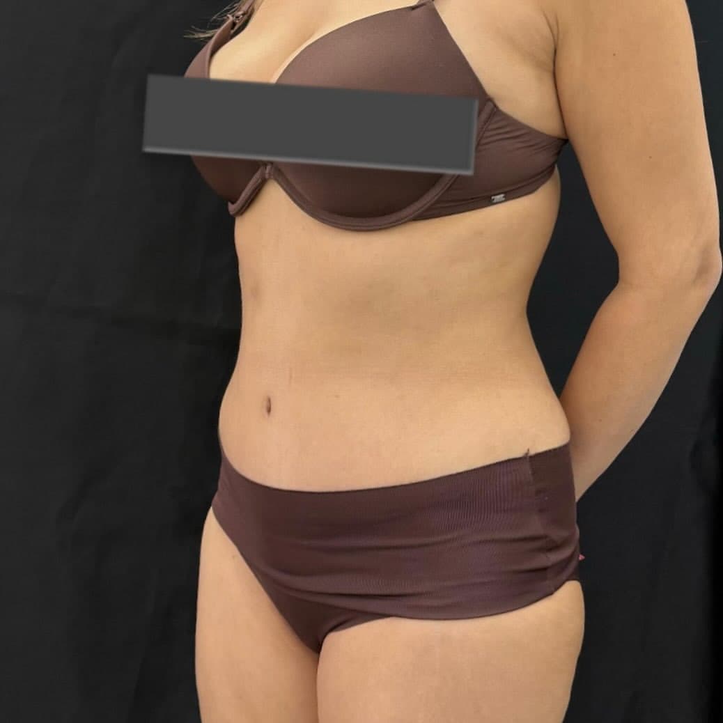 Liposuction and tummy tuck face right new