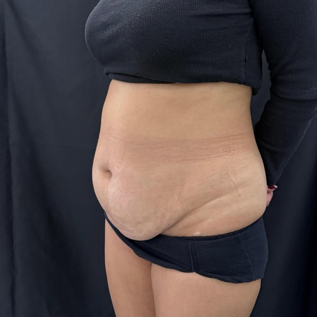 Liposuction and tummy tuck face right old
