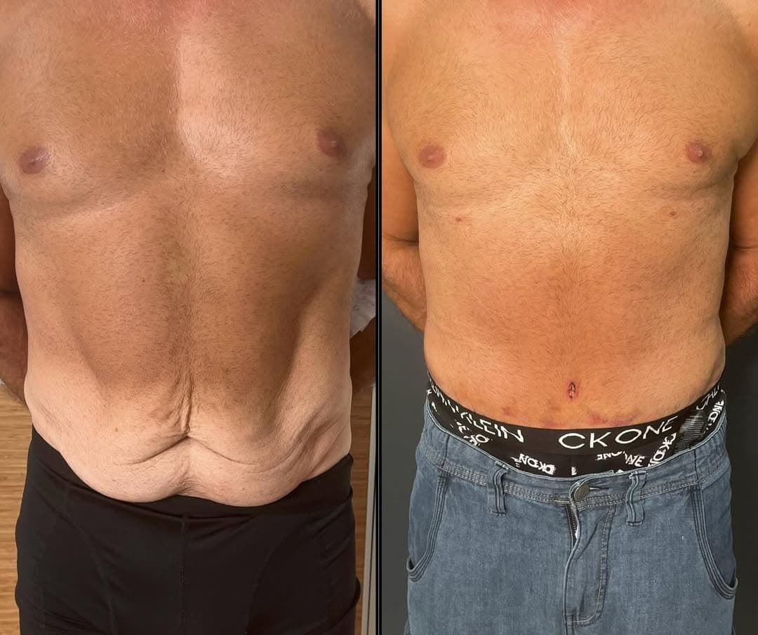 Male liposuction and tummy tuck