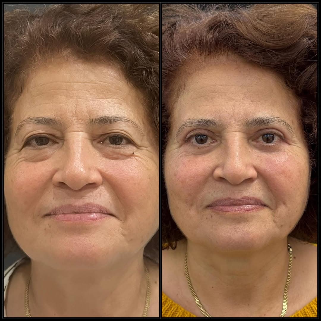 Upper and lower eyelid surgery