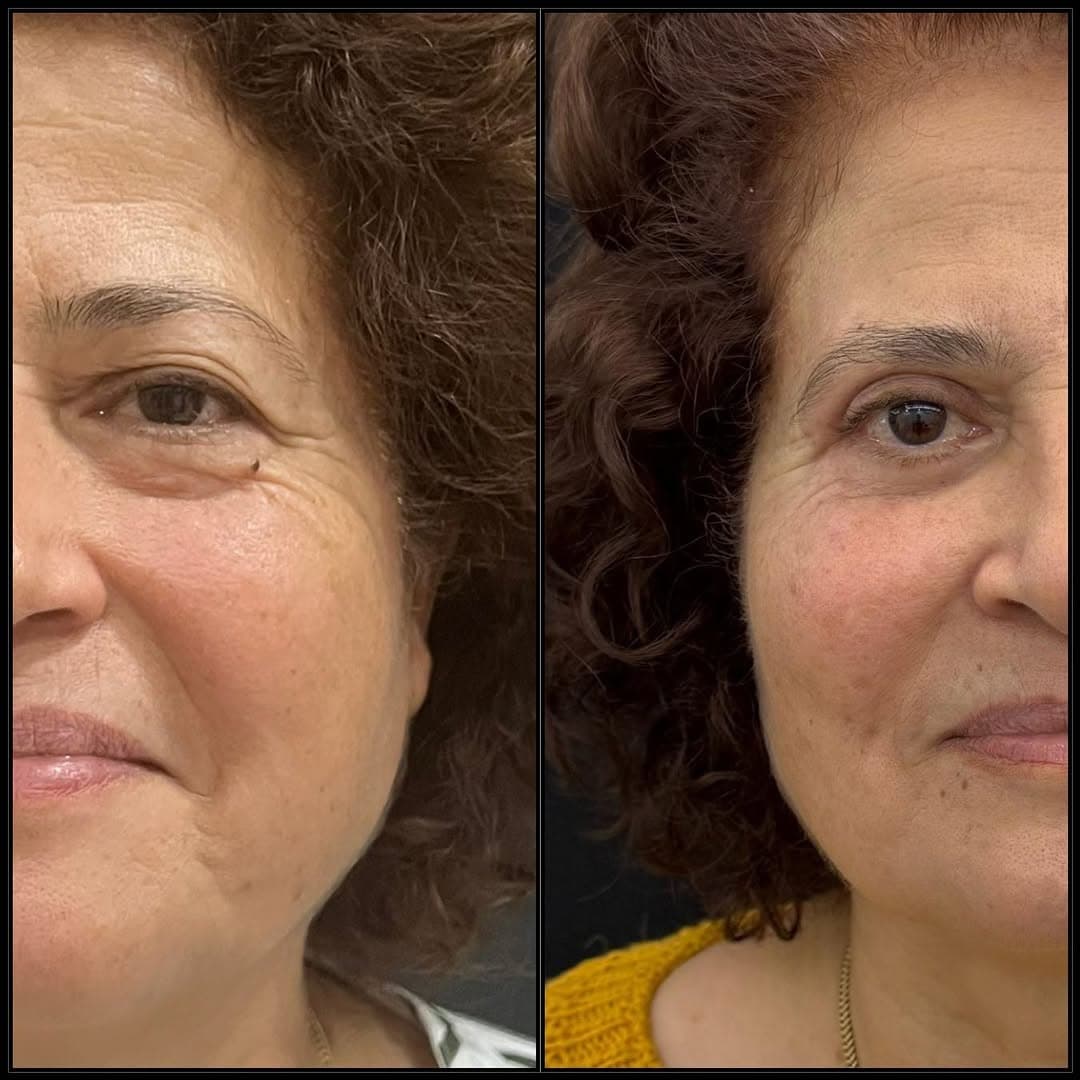 Upper and lower eyelid surgery zoomed in