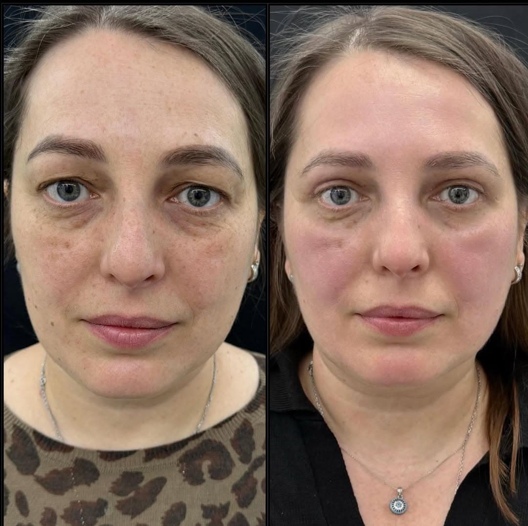 Upper eyelid surgery