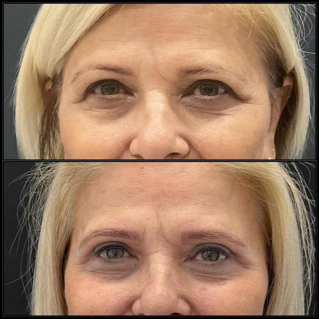 Upper eyelid surgery 2