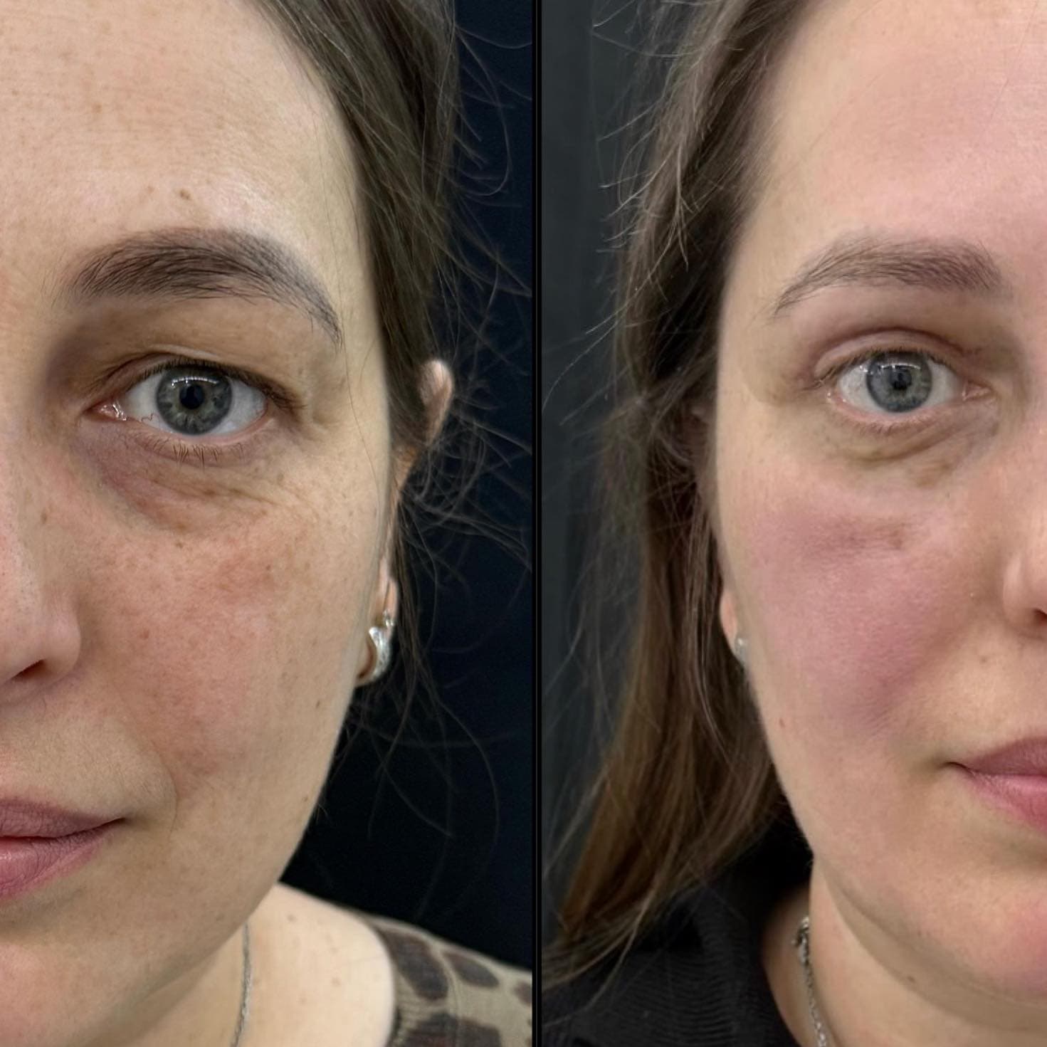 Upper eyelid surgery 3