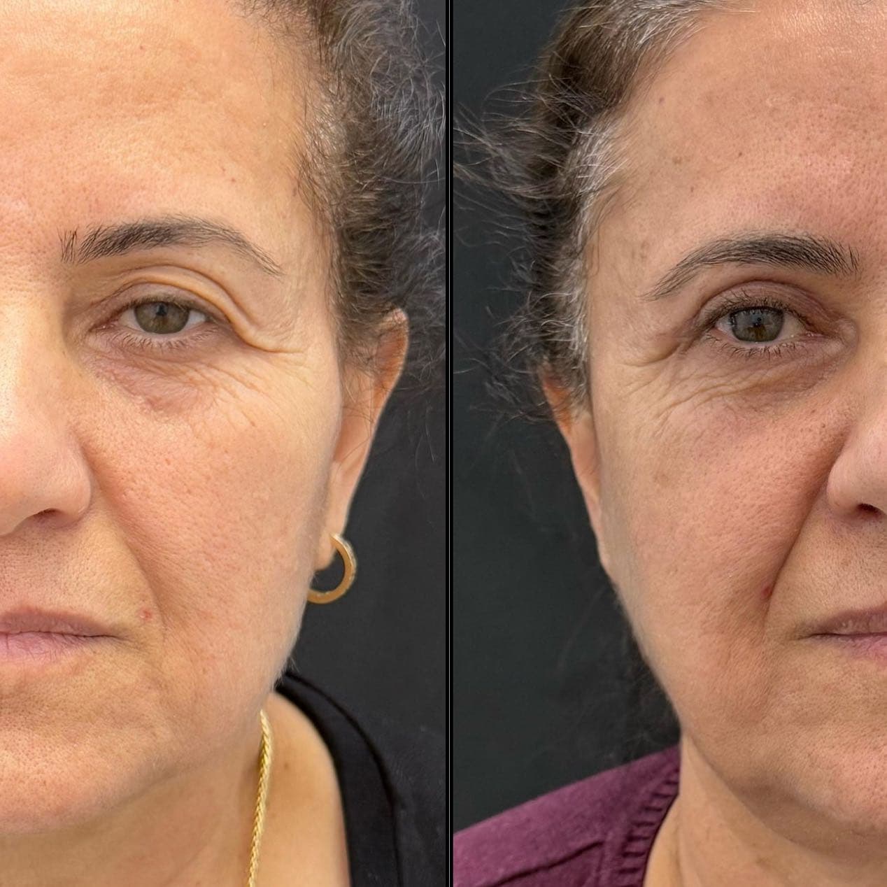 Upper eyelid surgery 4