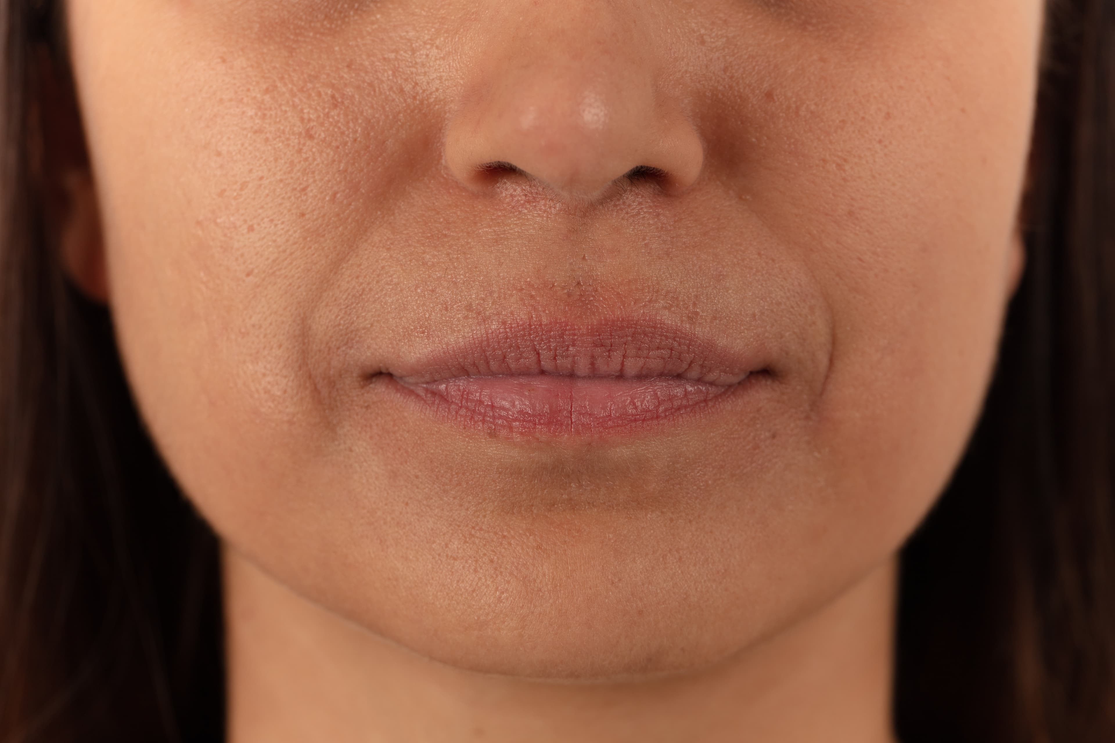 Lip Lift (Upper Lip Shortening)